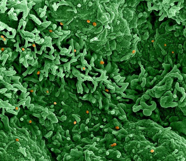 North Wales Chronicle: Handout image of a colorized scanning electron micrograph of monkeypox virus (orange) on the surface of infected cells. Picture: NIAID via PA Wire